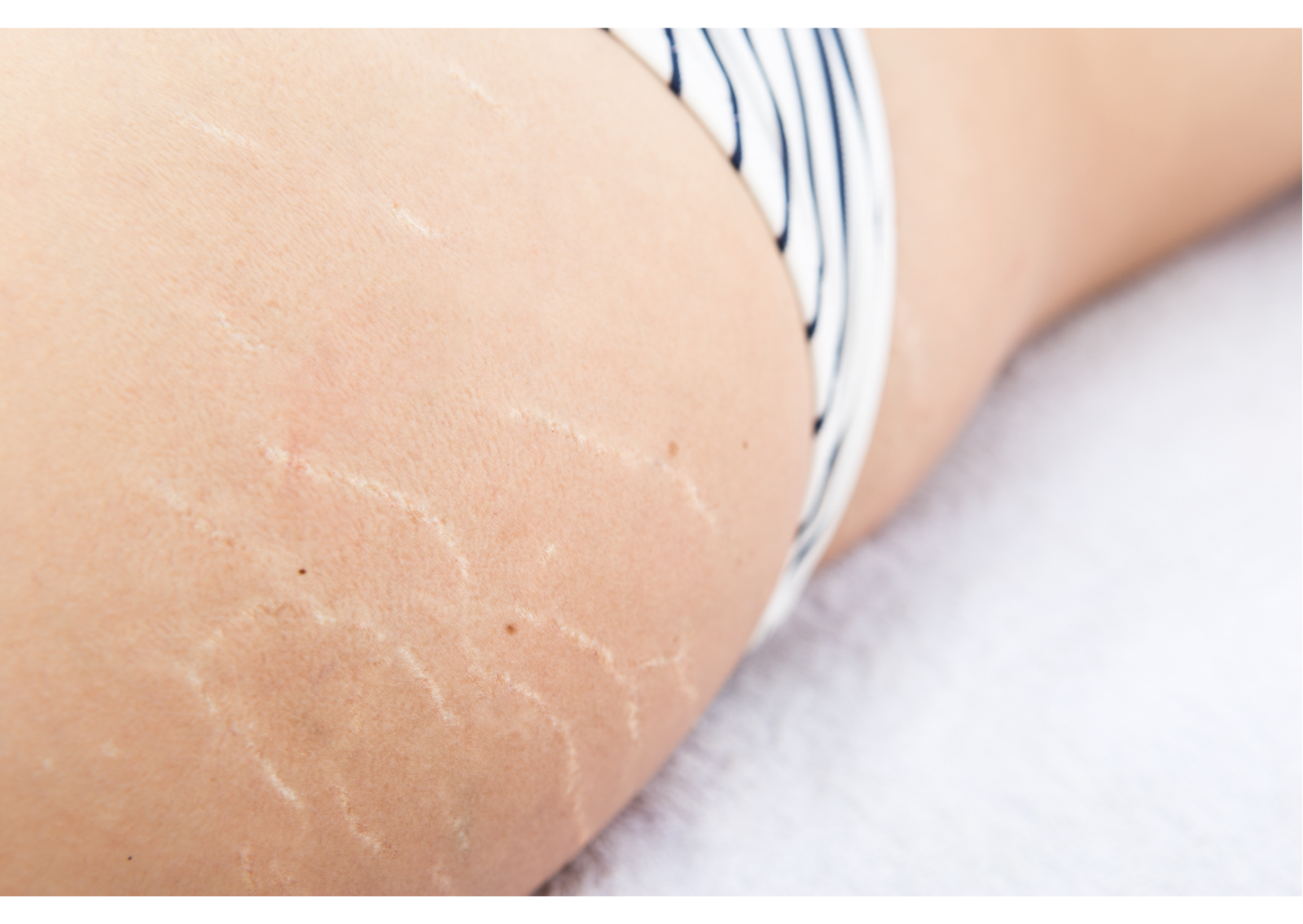 Formation en Skin repair, maquillage permanent reconstructeur : imitations d'aréoles, cicatrices et vergetures à Lyon et Marseille