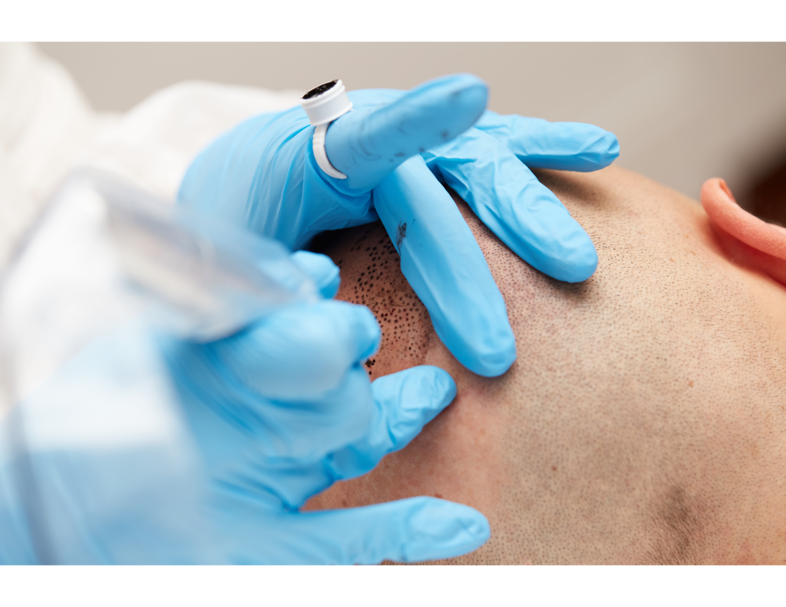 Formation en scalpigmentation (micropigmentation capillaire)  maquillage permanent du cuir chevelu, à Lyon et à Marseille