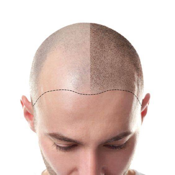 Formation perfectionnement en maquillage permanent du cuir chevelu : Tricopigmentation/ Scalp pigmentation à Lyon et Marseille