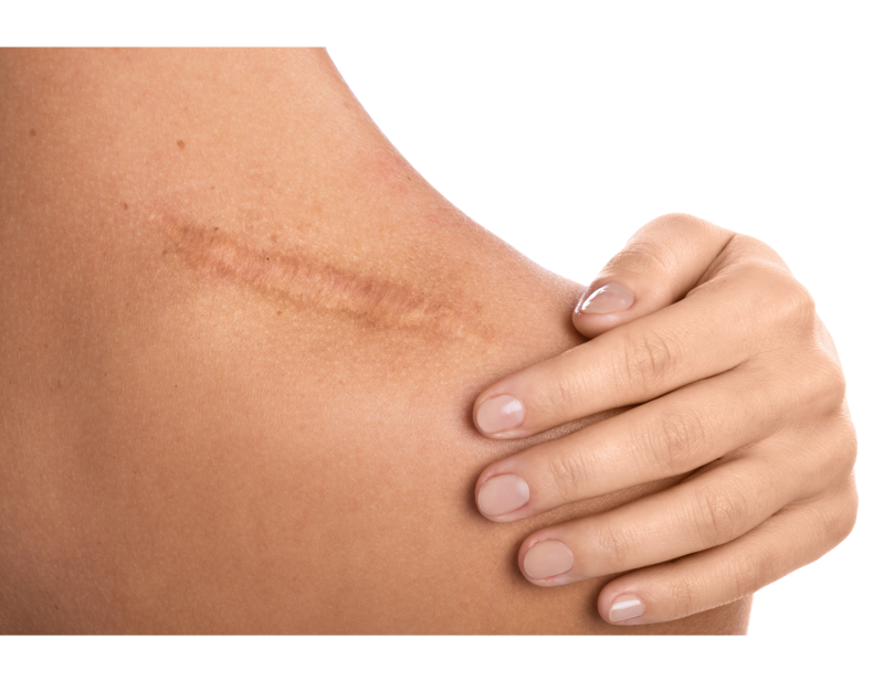 Formation d'initiation en Skin Repair : imitations d'aréoles, cicatrices et vergetures, à Lyon