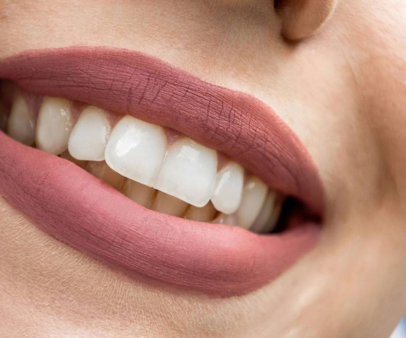 Formation blanchiment dentaire à Marseille